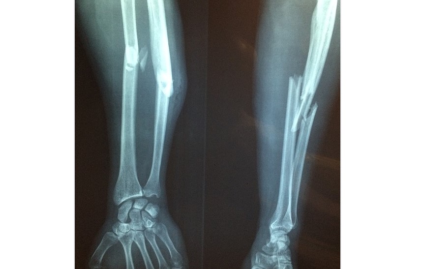 broken bone pixa